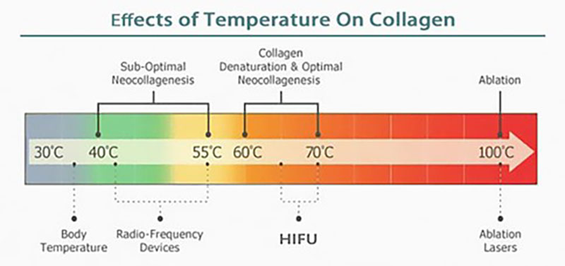 温度がコラーゲンに与える影響を示す図。30℃（体温）から100℃までの温度帯を色のグラデーションで表示し、40〜55℃は『最適未満のコラーゲン新生』、60〜70℃は『コラーゲンの変性と最適なコラーゲン新生』、100℃付近は『アブレーション（蒸散）』と説明。点線で機器の目安として、RF（高周波）機器は40〜55℃、HIFUは60〜70℃、アブレーションレーザーは100℃付近に位置づけられている。